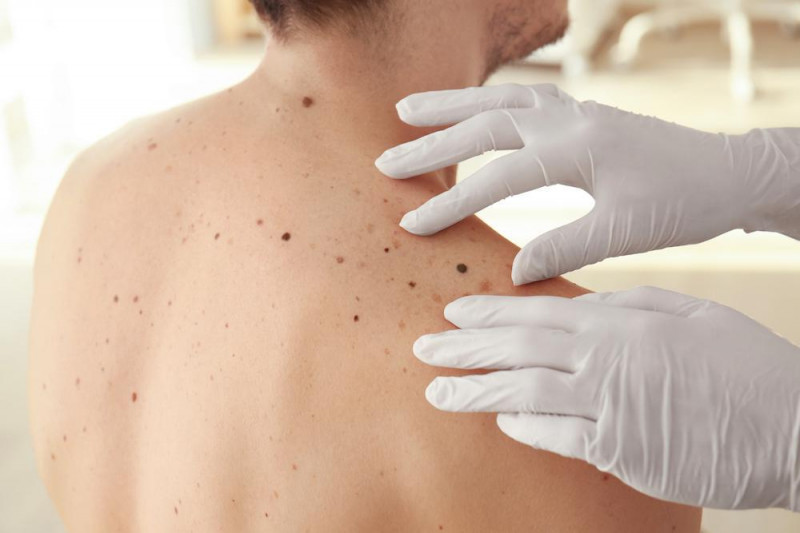 Screening And Removal Of Moles (Nevi)