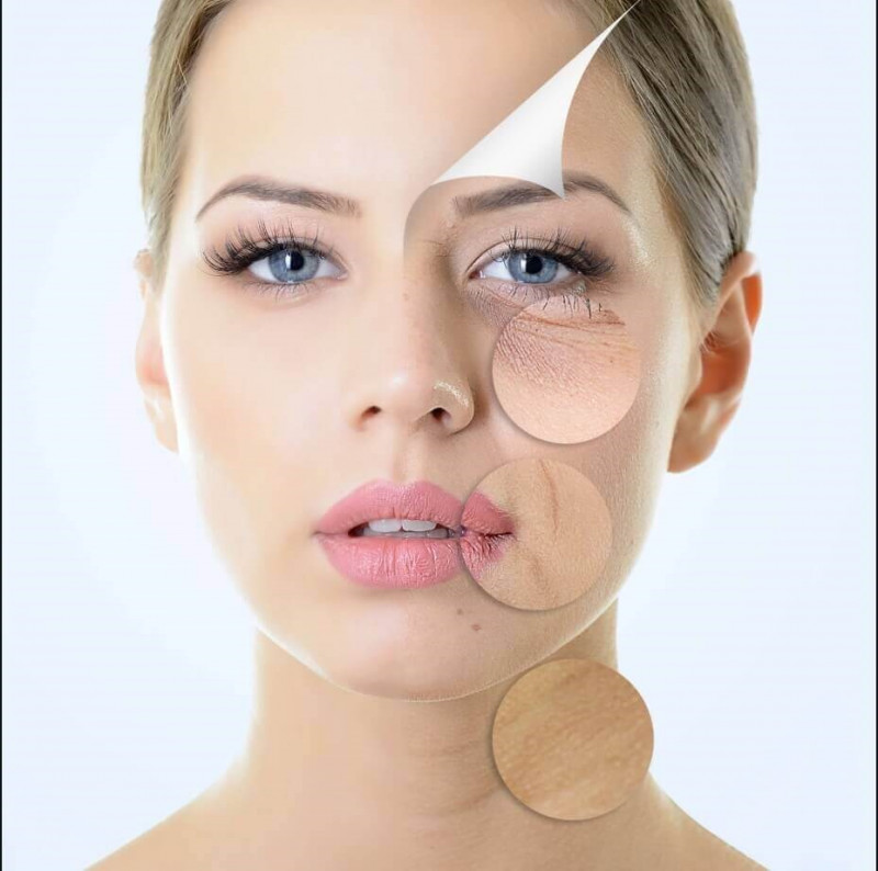 Lower Face And Neck Rejuvenation Surgery