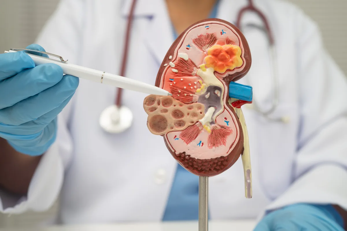 Kidney Stone Disease and Treatment