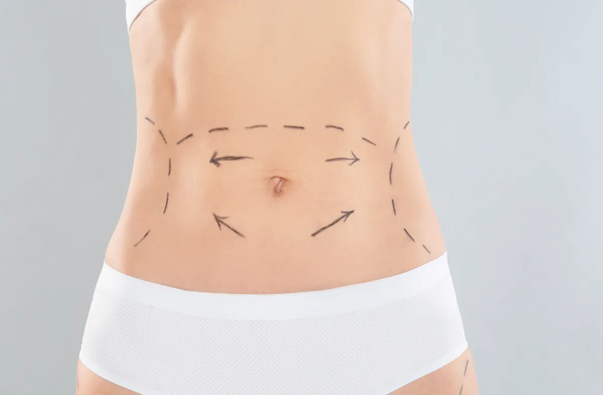 What is Abdominoplasty (Tummy Tuck)?